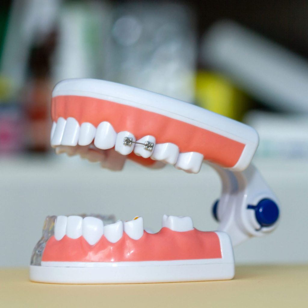 Partial Braces